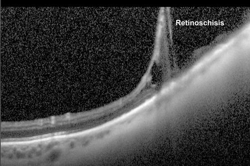 Peripheral Bullous Retinoschisis Spectral Domain Optical Coherence Tomography (SD-OCT)
64-year-old man with peripheral retinal problem noted during comprehensive eye examination. OD 20/32,  OS 20/25

