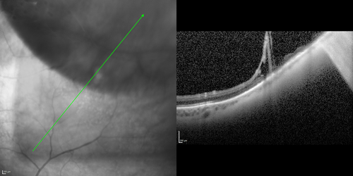 Peripheral Bullous Retinoschisis Spectral Domain Optical Coherence Tomography (SD-OCT)
64-year-old man with peripheral retinal problem noted during comprehensive eye examination. OD 20/32,  OS 20/25
