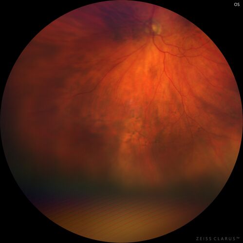 Retinoschisis confirmed with optical coherence tomography (OCT)
82 year old man with normal vision and peripheral retinoschisis confirmed with OCT scan.
