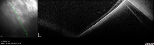 Retinoschisis confirmed with optical coherence tomography (OCT)
82 year old man with normal vision and peripheral retinoschisis confirmed with OCT scan.
