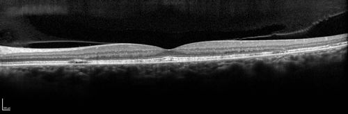 Multifocal Pattern Dystrophy
51 year old with normal vision - images look a lot like fundus flavimaculatus
