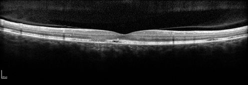 Multifocal Pattern Dystrophy
51 year old with normal vision - images look a lot like fundus flavimaculatus
