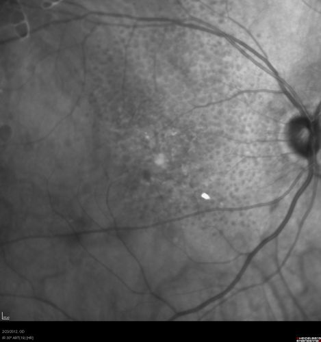 Reticular Macular Disease (Pseudo-drusen) Both Eyes - Occult CNVM and Macular Edema Right Eye 
Infra-Red
