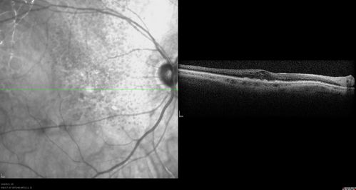 Reticular Macular Disease (Pseudo-drusen) Both Eyes - Occult CNVM and Macular Edema Right Eye 
Spectral Domain Optical Coherence Tomography
