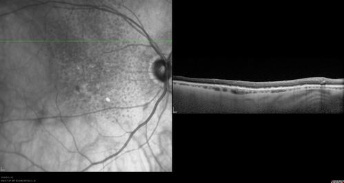 Reticular Macular Disease (Pseudo-drusen) Both Eyes - Occult CNVM and Macular Edema Right Eye 
Spectral Domain Optical Coherence Tomography
