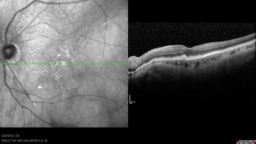 Reticular Macular Disease (Pseudo-drusen) Both Eyes - Occult CNVM and Macular Edema Right Eye 
Spectral Domain Optical Coherence Tomography
