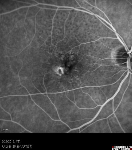 Reticular Macular Disease (Pseudo-drusen) Both Eyes - Occult CNVM and Macular Edema Right Eye 
Fluorescein Angiogram
