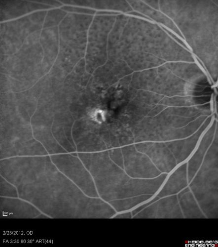 Reticular Macular Disease (Pseudo-drusen) Both Eyes - Occult CNVM and Macular Edema Right Eye 
Fluorescein Angiogram
