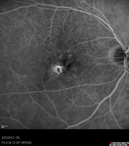 Reticular Macular Disease (Pseudo-drusen) Both Eyes - Occult CNVM and Macular Edema Right Eye 
Fluorescein Angiogram
