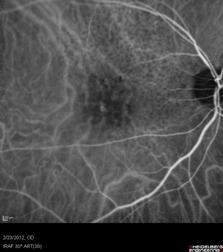Reticular Macular Disease (Pseudo-drusen) Both Eyes - Occult CNVM and Macular Edema Right Eye 
Indocyanine Green Angiogram
