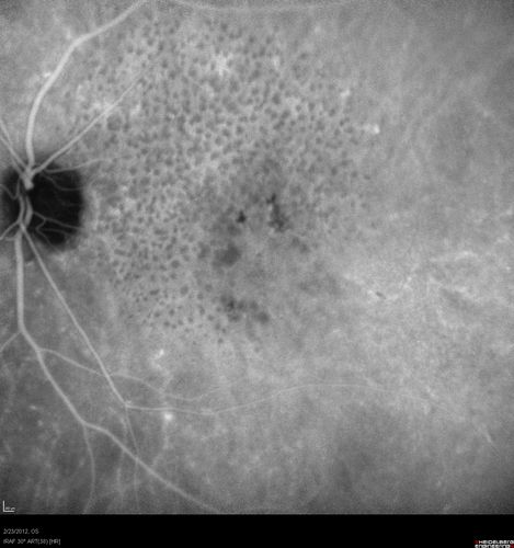 Reticular Macular Disease (Pseudo-drusen) Both Eyes - Occult CNVM and Macular Edema Right Eye
Indocyanine Green Angiogram
