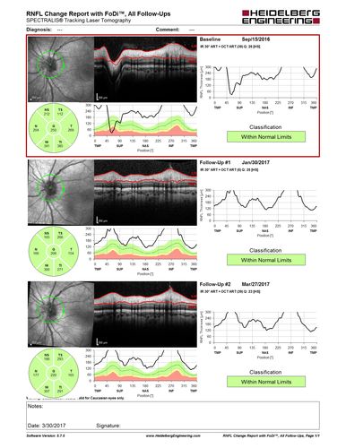 Neuroretinitis - NOT cat scratch - 5 year old
Presented with nerve swelling, serous RD and uveitis.  Ultimately responded to steroids and methotrexate.  ANA is positive.  All other extensive testing negative including MRI worried about MS

