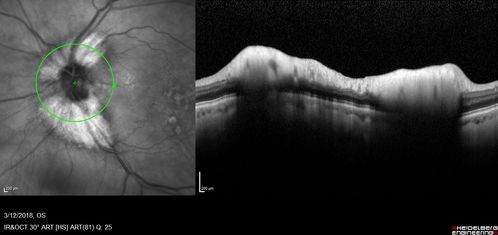 Myelinated Nerve Fiber Layer - Optic Nerve
Right eye subtle and inferior - left eye obvious
