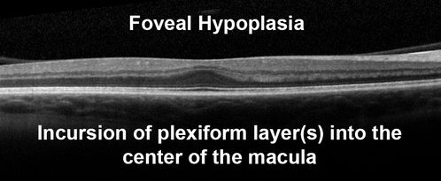 Foveal Hypoplasia in 23 year old patient with ROP

