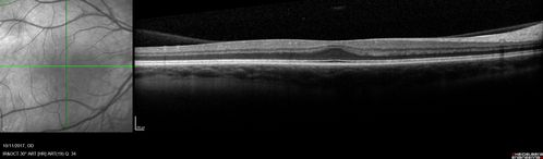 Foveal Hypoplasia in adult with ROP - good Vision
26 year old female Born at 1 lb 15 oz and had cryo for ROP at birth.  
VA OD: Dcc20/25
VA OS: Dcc20/20
SD OCT shows foveal hypoplasia
The SD OCT scan shows incursion of one or more of the plexiform layers into the center of the fovea.
