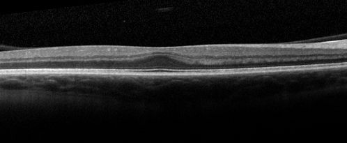 Foveal Hypoplasia in 23 year old patient with ROP
