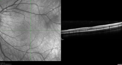 Foveal Hypoplasia in adult with ROP - good Vision
26 year old female Born at 1 lb 15 oz and had cryo for ROP at birth.  
VA OD: Dcc20/25
VA OS: Dcc20/20
SD OCT shows foveal hypoplasia
The SD OCT scan shows incursion of one or more of the plexiform layers into the center of the fovea.
