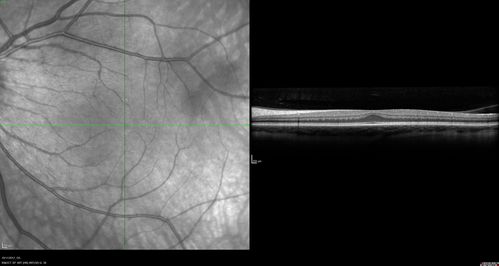 Foveal Hypoplasia in adult with ROP - good Vision
26 year old female Born at 1 lb 15 oz and had cryo for ROP at birth.  
VA OD: Dcc20/25
VA OS: Dcc20/20
SD OCT shows foveal hypoplasia
The SD OCT scan shows incursion of one or more of the plexiform layers into the center of the fovea.
