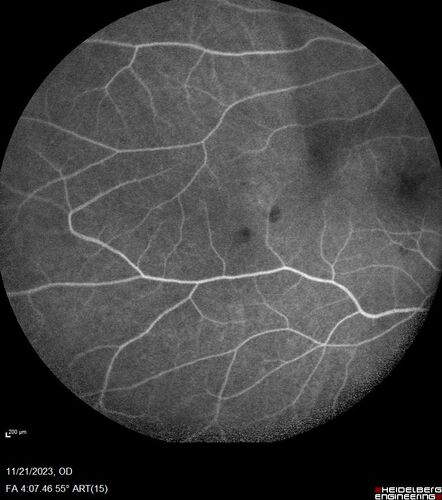 Roth Spot and Endocarditis
70 year old female - flu like symptoms with roth spot who was diagnosed by echo with endocarditis
