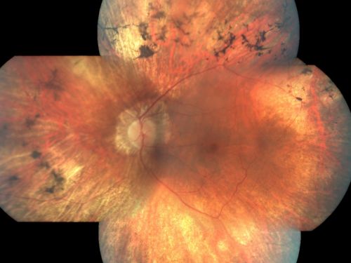 Retinitis Pigmentosa Newly Diagnosed 55 Year Old
55-year-old  noticed his vision declining recently, over the last few weeks, particularly in the right eye.  He said previous to that the vision was not normal but was pretty good.  OD is 20/100, OS is 20/50
OCT SCAN:  There is macular thickening in both eyes with intraretinal cysts.
