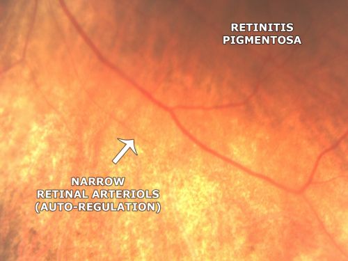 Retinitis Pigmentosa Newly Diagnosed 55 Year Old
55-year-old  noticed his vision declining recently, over the last few weeks, particularly in the right eye.  He said previous to that the vision was not normal but was pretty good.  OD is 20/100, OS is 20/50
OCT SCAN:  There is macular thickening in both eyes with intraretinal cysts.
