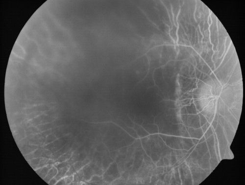 Retinitis Pigmentosa Newly Diagnosed 55 Year Old
55-year-old  noticed his vision declining recently, over the last few weeks, particularly in the right eye.  He said previous to that the vision was not normal but was pretty good.  OD is 20/100, OS is 20/50
OCT SCAN:  There is macular thickening in both eyes with intraretinal cysts.
