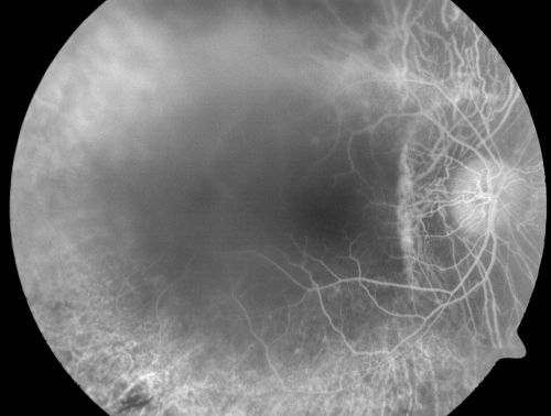 Retinitis Pigmentosa Newly Diagnosed 55 Year Old
55-year-old  noticed his vision declining recently, over the last few weeks, particularly in the right eye.  He said previous to that the vision was not normal but was pretty good.  OD is 20/100, OS is 20/50
OCT SCAN:  There is macular thickening in both eyes with intraretinal cysts.
