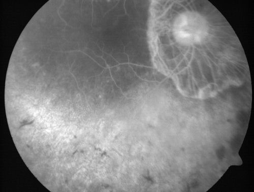 Retinitis Pigmentosa Newly Diagnosed 55 Year Old
55-year-old  noticed his vision declining recently, over the last few weeks, particularly in the right eye.  He said previous to that the vision was not normal but was pretty good.  OD is 20/100, OS is 20/50
OCT SCAN:  There is macular thickening in both eyes with intraretinal cysts.
