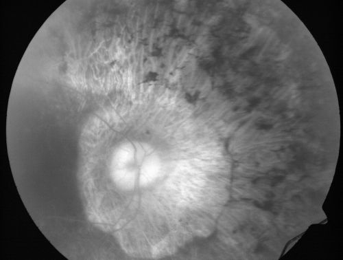Retinitis Pigmentosa Newly Diagnosed 55 Year Old
55-year-old  noticed his vision declining recently, over the last few weeks, particularly in the right eye.  He said previous to that the vision was not normal but was pretty good.  OD is 20/100, OS is 20/50
OCT SCAN:  There is macular thickening in both eyes with intraretinal cysts.
