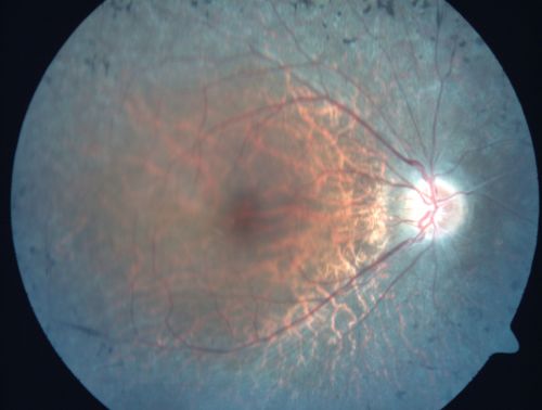 Retinitis Pigmentosa 32 Year Old Woman - 20/25 vision both eyes
32-year-old woman was seen in the office on 6/26/2009.  She has had retinitis pigmentosa since 2003.    She has difficulty with night vision but overall she is doing pretty well.
Vision OU is 20/25. 
