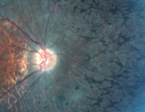 Retinitis Pigmentosa 32 Year Old Woman - 20/25 vision both eyes
32-year-old woman was seen in the office on 6/26/2009.  She has had retinitis pigmentosa since 2003.    She has difficulty with night vision but overall she is doing pretty well.
Vision OU is 20/25. 
