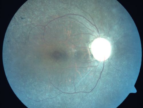 Concentric Annular Macular Dystrophy 4/200 2/200 vision 61 Year Old Macular Crystals
61-year-old woman has concentric annular macular dystrophy. She has had vision loss for 10 years who is no longer able to function even with the magnifiers and vision aids that she has.  Her brother who is ten years younger than her, is recently diagnosed with the same macular dystrophy and her father and grandfather may have had similar problems in the past.  

VISUAL ACUITY:  OD 4/200,  OS 2/200.
