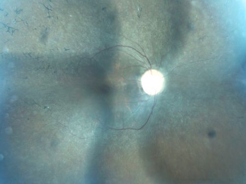 Concentric Annular Macular Dystrophy 4/200 2/200 vision 61 Year Old Macular Crystals
61-year-old woman has concentric annular macular dystrophy. She has had vision loss for 10 years who is no longer able to function even with the magnifiers and vision aids that she has.  Her brother who is ten years younger than her, is recently diagnosed with the same macular dystrophy and her father and grandfather may have had similar problems in the past.  

VISUAL ACUITY:  OD 4/200,  OS 2/200.
