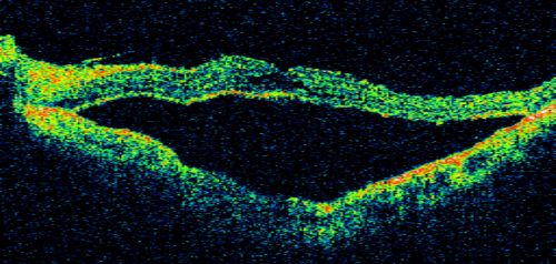 Retinal Pigment Epithelial Dysgenesis
