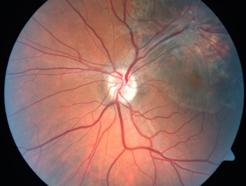 Retinal Pigment Epithelial Dysgenesis
