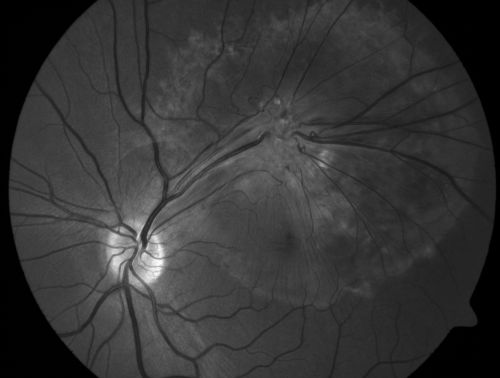 Retinal Pigment Epithelial Dysgenesis
