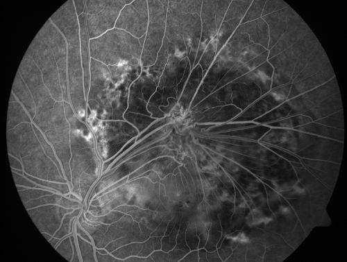Retinal Pigment Epithelial Dysgenesis
