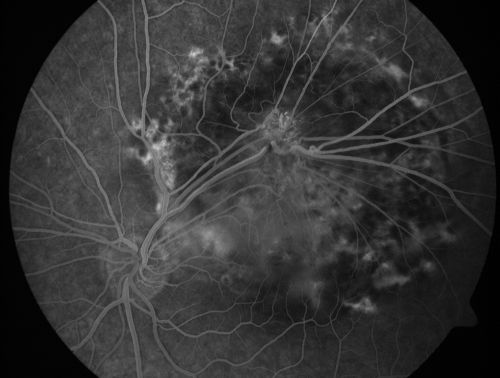 Retinal Pigment Epithelial Dysgenesis
