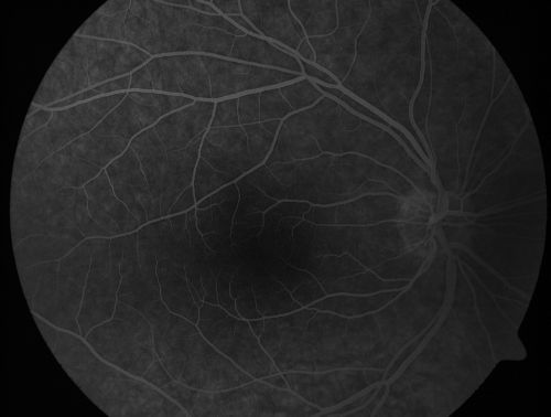 Retinal Pigment Epithelial Dysgenesis
