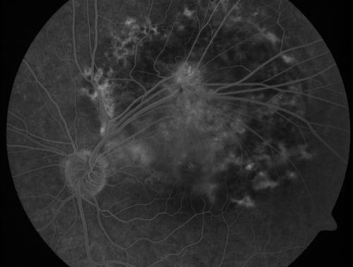 Retinal Pigment Epithelial Dysgenesis

