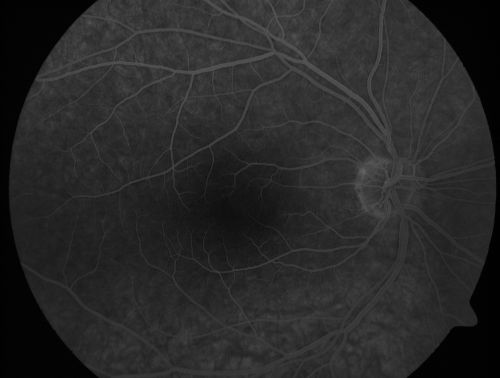 Retinal Pigment Epithelial Dysgenesis

