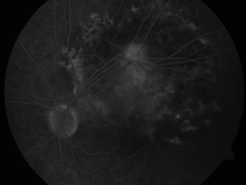 Retinal Pigment Epithelial Dysgenesis

