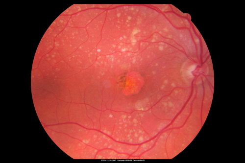 Small Retinal Pigment Epithelial Rip and Poor Vision (20/400)
80-year-old woman vision in the right eye has substantially declined.  
  OD:  20/400;  OS:  20/50
