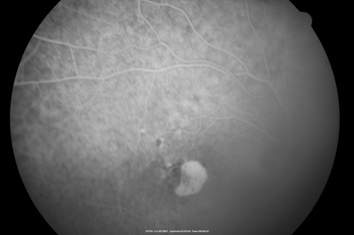 Small Retinal Pigment Epithelial Rip and Poor Vision (20/400)
80-year-old woman vision in the right eye has substantially declined.  
  OD:  20/400;  OS:  20/50
