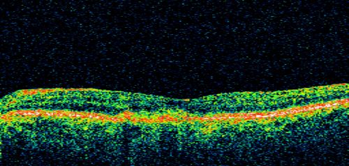 Small Retinal Pigment Epithelial Rip and Poor Vision (20/400)
80-year-old woman vision in the right eye has substantially declined.  
  OD:  20/400;  OS:  20/50
