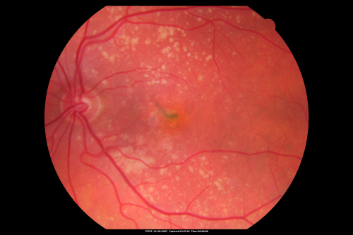 Small Retinal Pigment Epithelial Rip and Poor Vision (20/400)
80-year-old woman vision in the right eye has substantially declined.  
  OD:  20/400;  OS:  20/50
