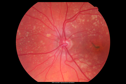 Small Retinal Pigment Epithelial Rip and Poor Vision (20/400)
80-year-old woman vision in the right eye has substantially declined.  
  OD:  20/400;  OS:  20/50
