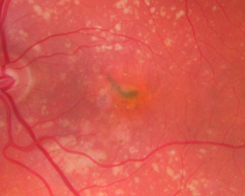 Small Retinal Pigment Epithelial Rip and Poor Vision (20/400)
80-year-old woman vision in the right eye has substantially declined.  
  OD:  20/400;  OS:  20/50
