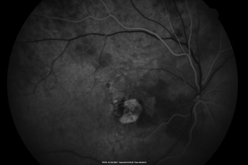 Small Retinal Pigment Epithelial Rip and Poor Vision (20/400)
80-year-old woman vision in the right eye has substantially declined.  
  OD:  20/400;  OS:  20/50
