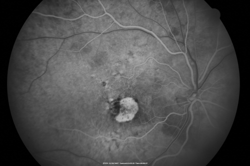 Small Retinal Pigment Epithelial Rip and Poor Vision (20/400)
80-year-old woman vision in the right eye has substantially declined.  
  OD:  20/400;  OS:  20/50
